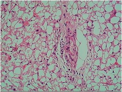 Late-Onset Carnitine–Acylcarnitine Translocase Deficiency With SLC25A20 c.199-10T>G Variation: Case Report and Pathologic Analysis of Liver Biopsy